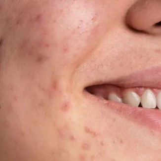 akne sivilce tedavisi Ozel